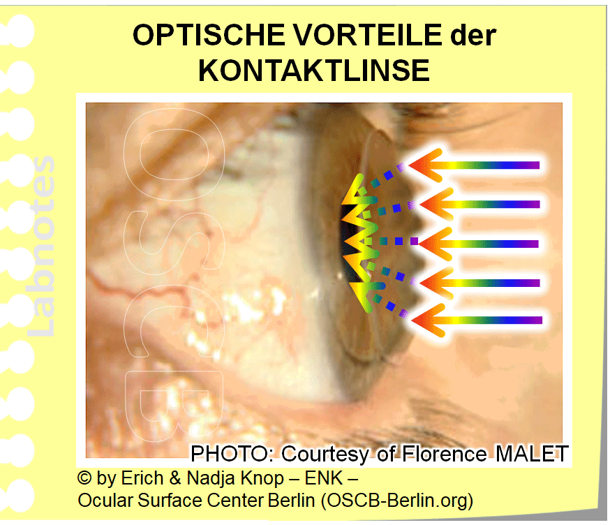 Harte/ ´Formstabile´ Kontaktlinsen sind typischerweise kleiner und liegen nur auf der Hornhaut. Sie erfordern eine gewisse Eingewühnungszeit für den Träger und daher sind wie weniger weit verbreitet aber sie haben eine überlegene Qualität von Material und Optk.