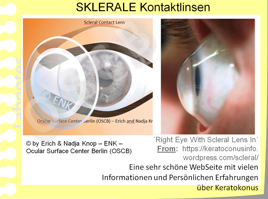 OSCB-Berlin.org_SKLERALE-KONTAKTLINSE-auf-dem-Auge,-Foto-von-der-Seite-(FOTO-von-keratoconusinfo.wordpress.com).gif