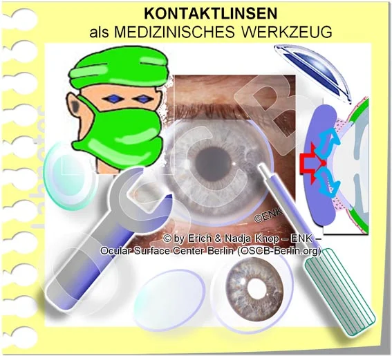 OSCB-Berlin.org_(c)ENK_Trockenes-Auge,-Dry-Eye-Disease,-Contact-Lens,-Kontaktlinse__Kontaktlinen als MEDIZINISCHES WERKZEUG_GANZ OHNE Text_jpg6 20 DEUTSCH_.jpg