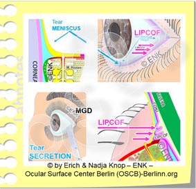 CLINICAL SIGNS of Dry Eye