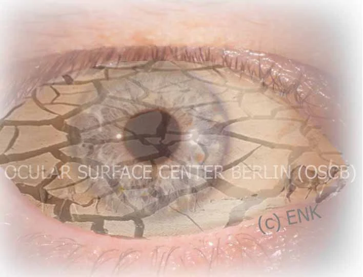 6_OSCB-Berlin.org_(c)ENK_DRY EYE BANNER,_Augenoberfläche FOTO EIGENES AUGE (AUS; hier hell + kontrastreich) WEICH 30 + Sättigung_TROCKENES AUGE, DRY EYE, WÜSTE KAMELE.jpg