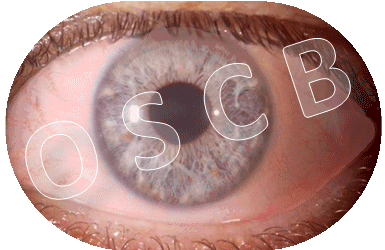 Animation_www.OSCB-Berlin.org,-©--Erich-and-Nadja-KNOP---ENK--_Rotes-TROCKENES-AUGE,-Red-DRY-EYE_400-3-0,5_.gif