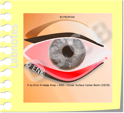 Animation_Ectropion,-Ektropium_NEU-auf-gelbem-Zettel_400-4-0,2_.gif