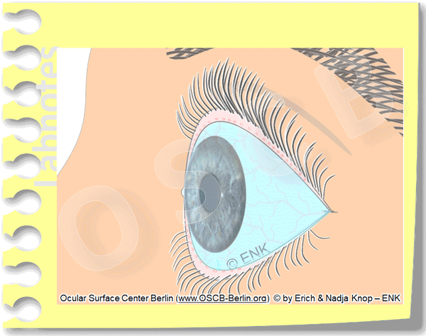 Animation_Trocknes-Auge,-Dry-Eye_Einfach,-Zum-Einstieg-für-FACTS_Zugeschnitten+600_15-600-0,3.gif
