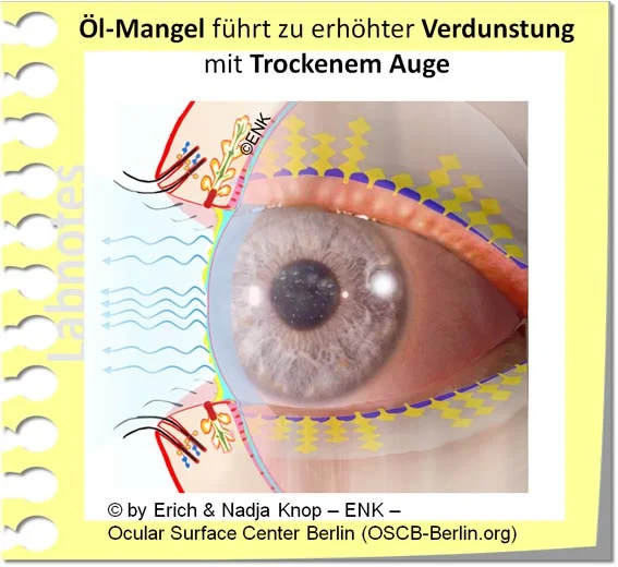 OSCB-Berlin.org_(c)ENK_Trockenes-Auge,-Dry-Eye-Disease,-Contact-Lens,-Kontaktlinse____Öl-Mangel führt zu erhöhter Verdunstung mit Trockenem Auge_20_.jpg
