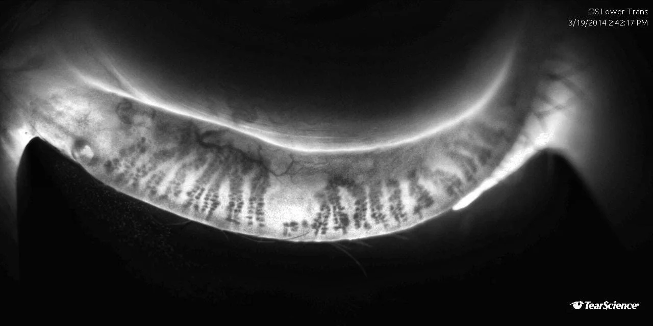 JnJ TearScience LipiVIEW FOTO 2 Meibomdrüse in TRANSILLUMINATION_dmi-adaptive_full.jpg