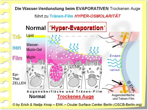 Bei Erhöhter Verdunstung (blaue Pfeile) des Tränenwassers werden die gelösten Stoffe (Salze und Proteine - in der Abb. als weisse Kugeln) stärker konzentriert. Dies führt zu lokal dünnem mit erhöhter Salzkonzentration (Hyperosmolarität), und damit zu Augen Brennen und Zellschädigung .