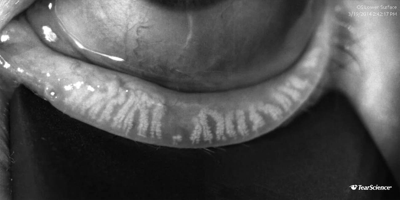 JnJ TearScience LipiVIEW FOTO Meibomdrüse in DYNAMIC IMAGING_dmi-dynamic_full.jpg
