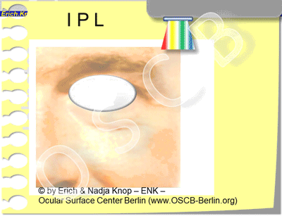 DEUTSCH IPL Meibomian Glands - IPL - Intense Pulsed Light-Therapy ...