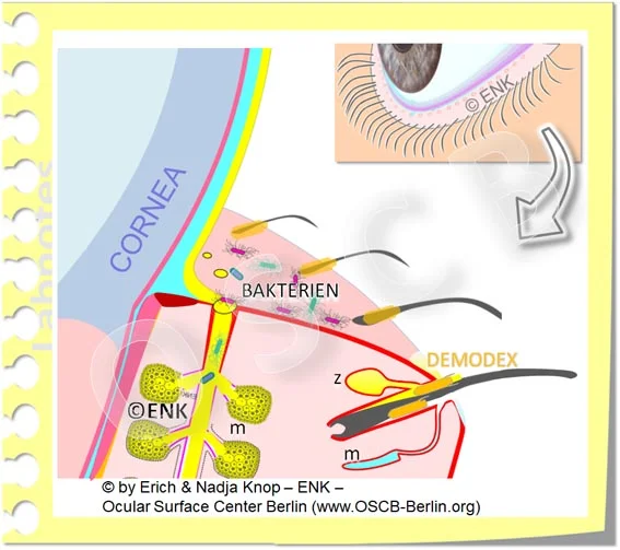 www.OSCB-Berlin.org_DEMODEX Milben und BAKTERIEN Normale Flora auf dem Lidrand bei Meibomdrüsen Störung, MDD, MGD und BLEPHARITIS 2_20_.jpg