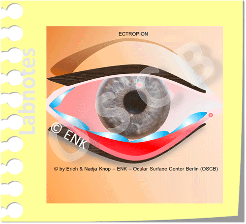 OSCB_LIDER-(FRONTAL)-Animation-(ENK)-BLINZELN_+ECTROPION_2-mit-Gelbem-Zettel,-+-Tränenfluss,-langsam__.gif