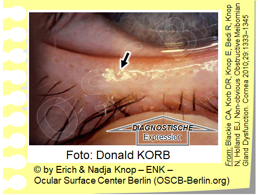 OSCB-Berlin.org_Die-Fette-der-MEIBOMDDRÜSEN-bilden-ein-klares-ÖL-bei-Körpertemperatur,-das-durch-die-Drüsenöffnung-auf-den-Lidrand-abgegeben-wird-+-DIAGNOSTISCHE-EXPRESSION_.gif