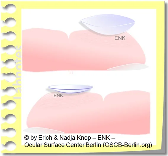 Soft/ flexible contact lenses (top) are the most popular type and they are somewhat larger than the rigid/ gas permeable contact lenses (bottom)