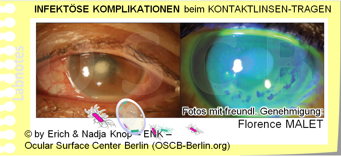 OSCB-Berliin.org_INFEKTÖSE-KOMPLIKATIONEN-beim-KONTAKTLINSEN-TRAGEN-(Fotos;-FLORENCE-MALET).gif