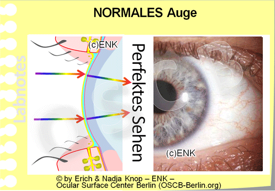 Die gesamte Augenoberfläche ist ein integriertes Funktionssystem ... in dem alle Anteile funktionieren müssen um die Gesamtgesundheit und damit das scharfe Sehen zu erhalten. Störungen des Lidrandes, vor allem im Bereich der hinteren Lidkante können die Stabilität des Tränenfilms erheblich stören, da er (1) durch durch den Lid Wiper der hinteren Lidkante erst dünn und gleichmäßig hergestellt werden kann und (2) der Tränenfilm auf der hinteren Lidkante als Basis ruht. Bei Störungen der Lidkante kann ein Trockenes Auge eine typische Folge sein.