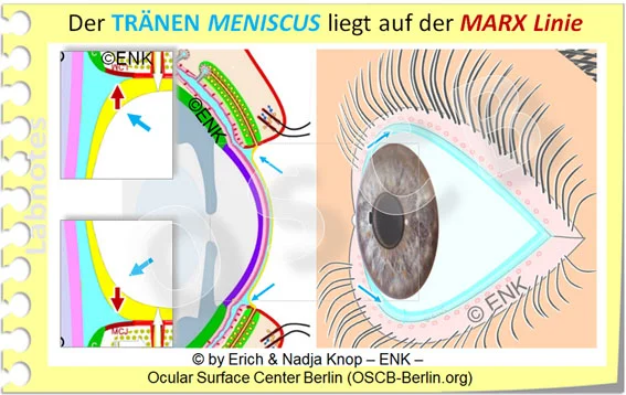 Der TRÄNENMENISKUS (blaue Pfeile in allen Schemazeichnungen) ist das deutlich verdickte ´ENDE´ des Tränenfilms, dort wo er den Lidrand berührt. Die Bildung des Tränenmeniskus (´Tränensee´), der mehr Tränenflüssigkeit enthält als der Tränenfilm selbst und im Querschnitt (Abb. links) etwa dreieckig ist, hängt mit der Oberflächenspannung zusammen. In starker Vergrößerung (Ausschnitte ganz rechts) erkennt man, dass der Tränenmeniskus auf der MARX´schen Linie liegt (rotbraune Pfeile, ganz links), die wiederum die Oberfläche der Haut-Schleimhaut-Grenze (MCJ) ist - Dies ist die vordere, erste Zone der hinteren Lidkante. Das Lid berührt mit der hinteren, zweiten, Zone den Augapfel/Bulbus - dort bildet die marginale Konjunktiva die verdickte Epithel-Lippe des Lid Wiper, der die Tränen zum sehr dünnen Tränenfilm auszieht. Die Lidränder des Auges auf der Schemazeichnung rechts sind leicht nach außen evertiert damit man den Lidrand komplett sehen kann, ganz hinten auf dem freien Lidrand liegen die Öffnungen der Meibomdrüsen, noch vor dem Tränenmeniskus.
