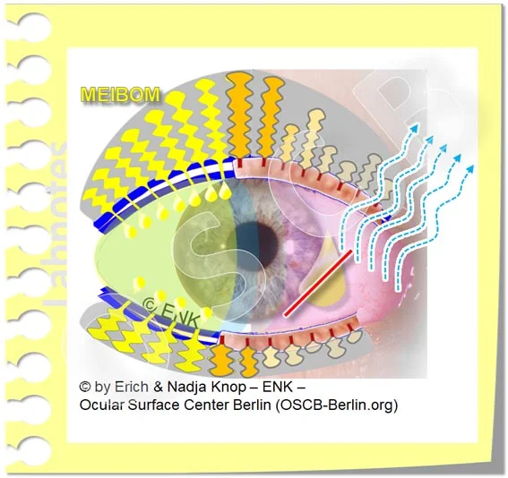 OSCB-Berlin.org, (c) ENK_Dry Eye Disease MGD_Trockenes Auge mit Meibomdrüsen Dysfunktion (MDD) und LIPIDMANGEL 2 MGD_20_.jpg
