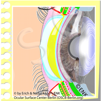 ANIMATION-HAUPT-PATHOLOGIEN-bei-MGD_Tear-Film-DRY-SPOT-+-Light-SCATTERING_+-OSCB_ZUGESCHNITTEN_NEU-mit-ZETTEL-NUR-CORNEA_15-11-0,7_.gif