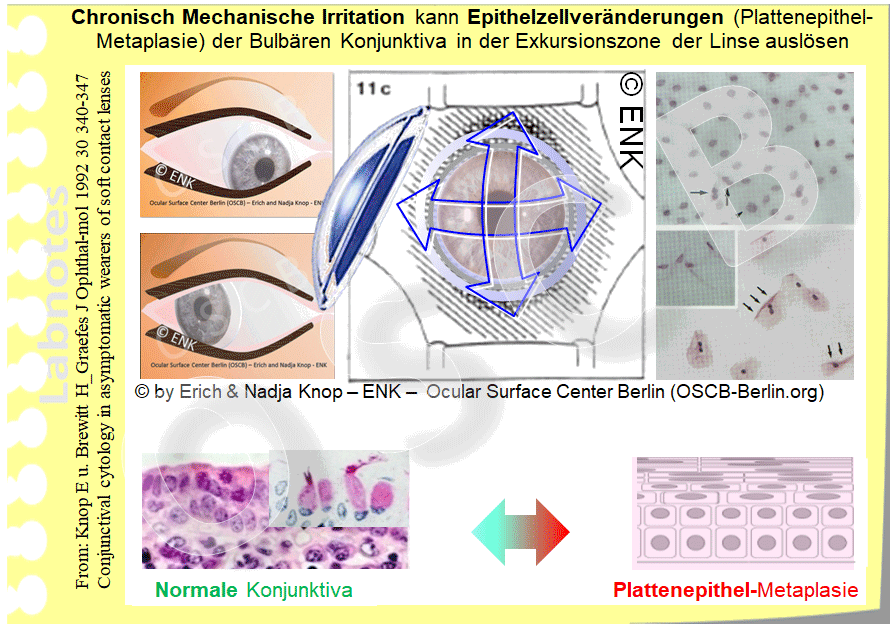OSCB-Berlin.org_(c)ENK_Trockenes-Auge,-Dry-Eye-Disease,-Contact-Lens,-Kontaktlinse__Chronisch-Mechanische-Irritation-Epithelzellveränderungen-(Plattenepithel-Metaplasie)-der-Bulbären-Konjunktiva.gif