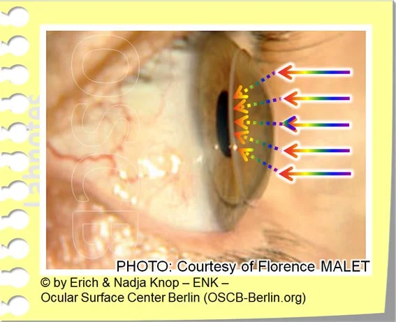 OSCB-Berlin.org_(c)ENK_Trockenes Auge, Dry Eye Disease, Contact Lens, Kontaktlinse_OPTISCHE VORTEILE der Kontaktlinse_OHNE Text_20_.jpg