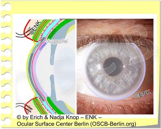 OSCB-Berlin.org_(c)ENK_Trockenes-Auge,-Dry-Eye-Disease,-Contact-Lens,-Kontaktlinse__Augenoberfläche und KONTAKTLINSE_20 OHNE Text_.jpg