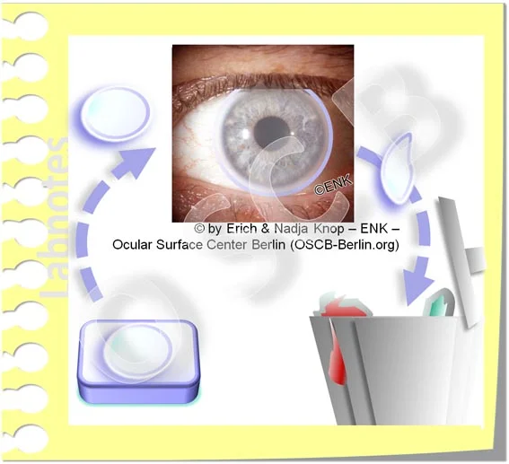 OSCB-Berlin.org, (c) ENK_Dry Eye Disease, Contact Lenses_Trockenes Auge_EINMAL KONTAKTLINSEN, TAGESLINSEN_20_.jpg