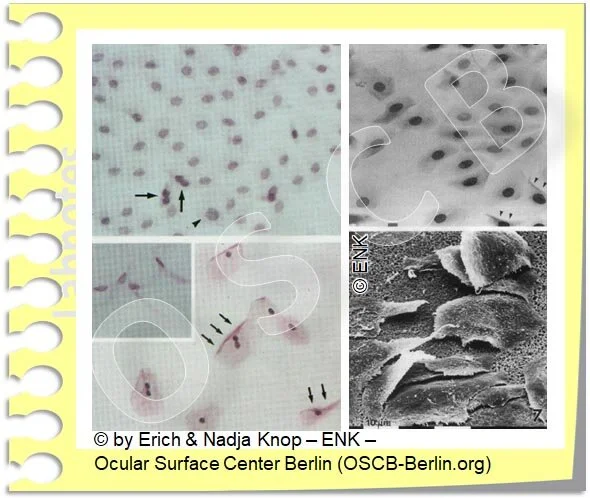 OSCB-Berlin.org, (c) ENK_Dry Eye, SQUAMOUS METAPLASIA_Trockenes Auge, PLATTENEPITHEL METAPLASIE (LM+SEM)_20_.jpg