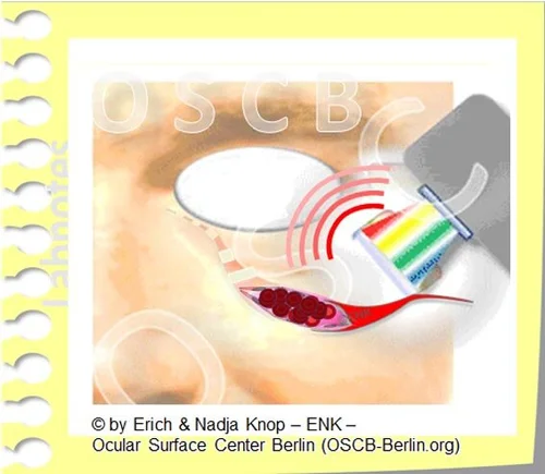 ENGLISCH IPL Meibomian Glands - IPL - Intense Pulsed Light-Therapy ...