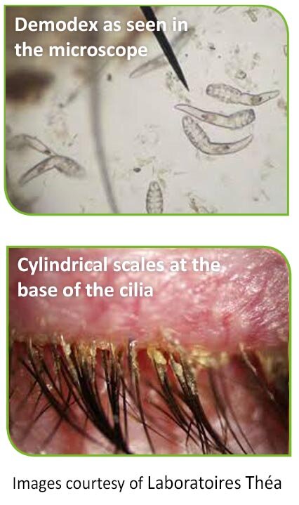 LID INFLAMMATION/Blepharitis - DEMODEX Ocular Surface Center Berlin