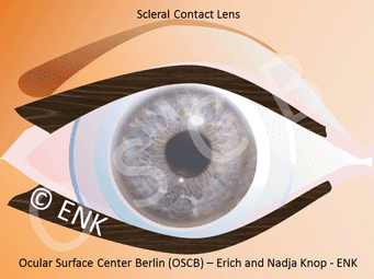Sklerale Kontaktlinsen
