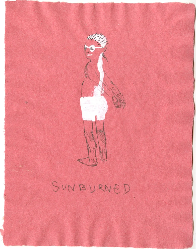 10_sunburn.jpg