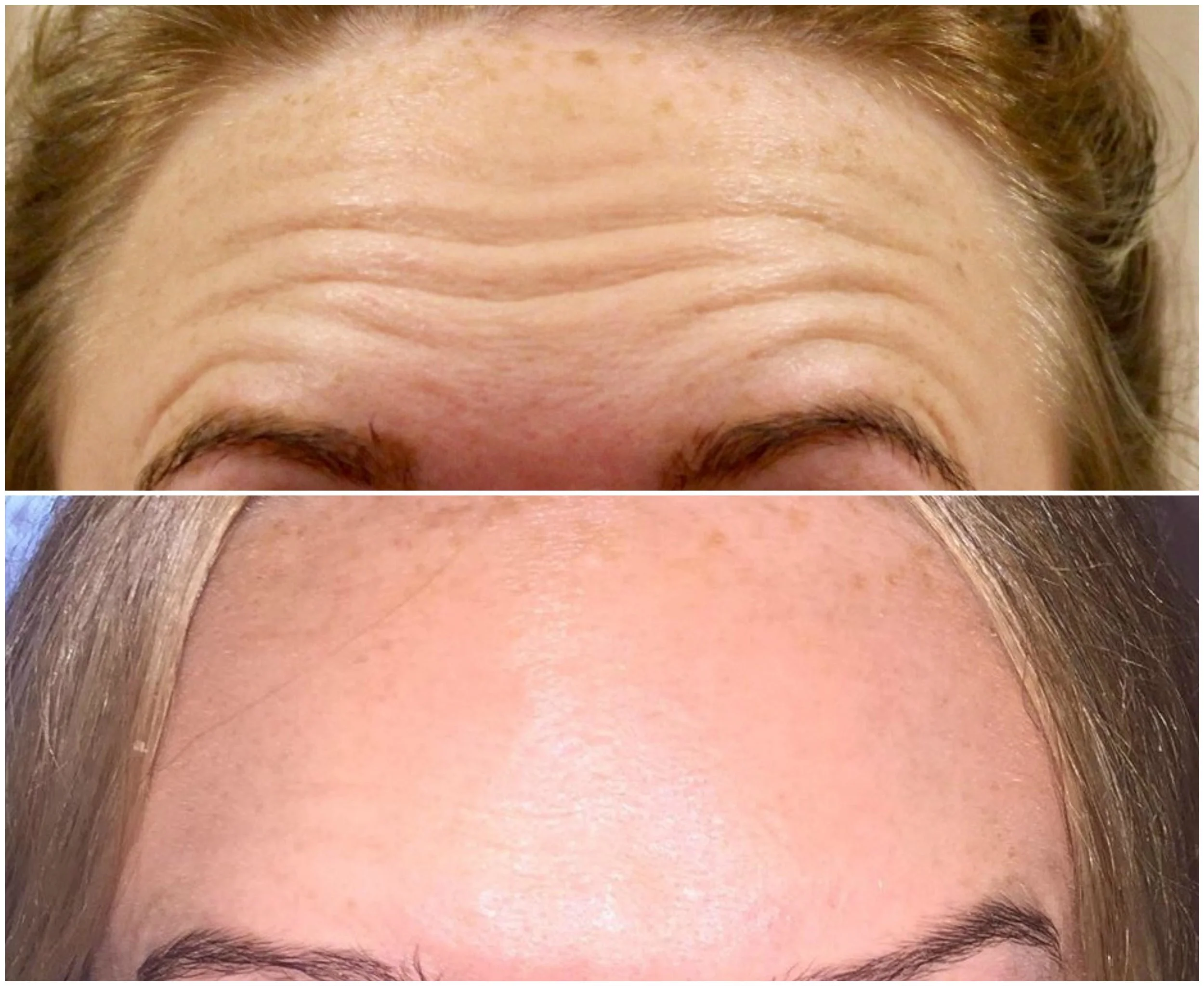 Forehead Frown Line - BOTOX®: Before and After, Escape Aesthetics