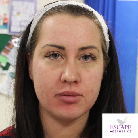 Skin Before AlumierMD