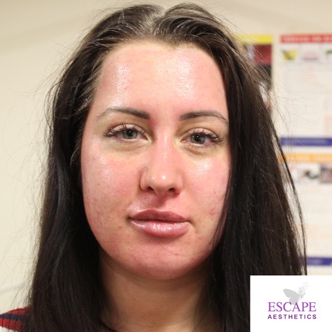 Skin Immediately After AlumierMD