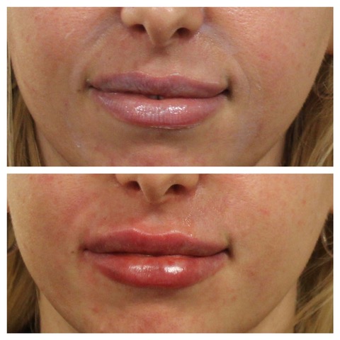 Before & After Smile Lines, Dermal Treatment