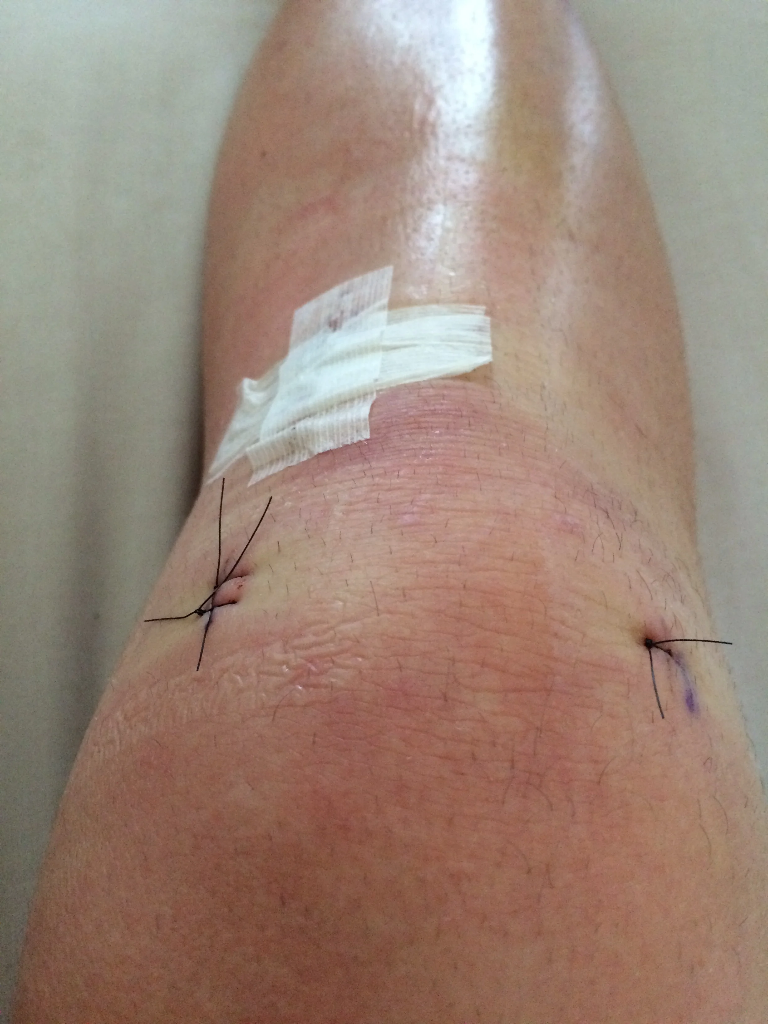 ACL Rehabilitation Program — Total Physiotherapy