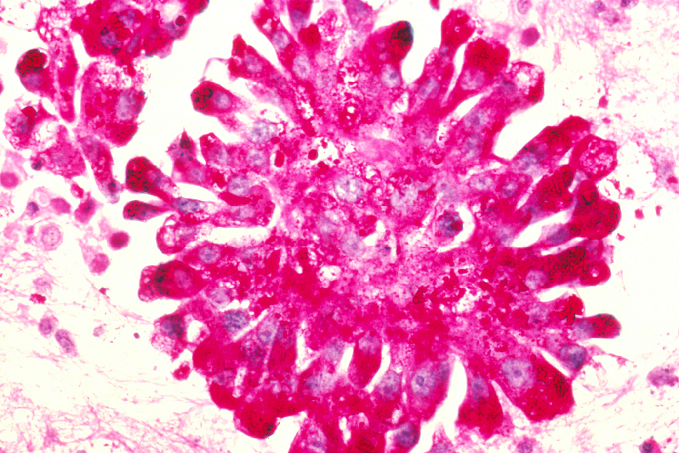 By (Image: Lance Liotta Laboratory) - Cancer-Causing Genes Can Convert Even the Most Committed Cells. PLoS Biology Vol. 3/8/2005, e276 doi:10.1371/journal.pbio.0030276, CC BY 2.5, https://commons.wikimedia.org/w/index.php?curid=1430234