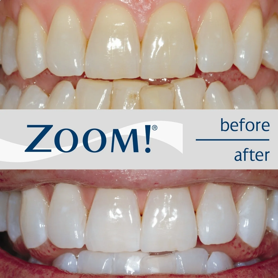 ZOOM Whitening