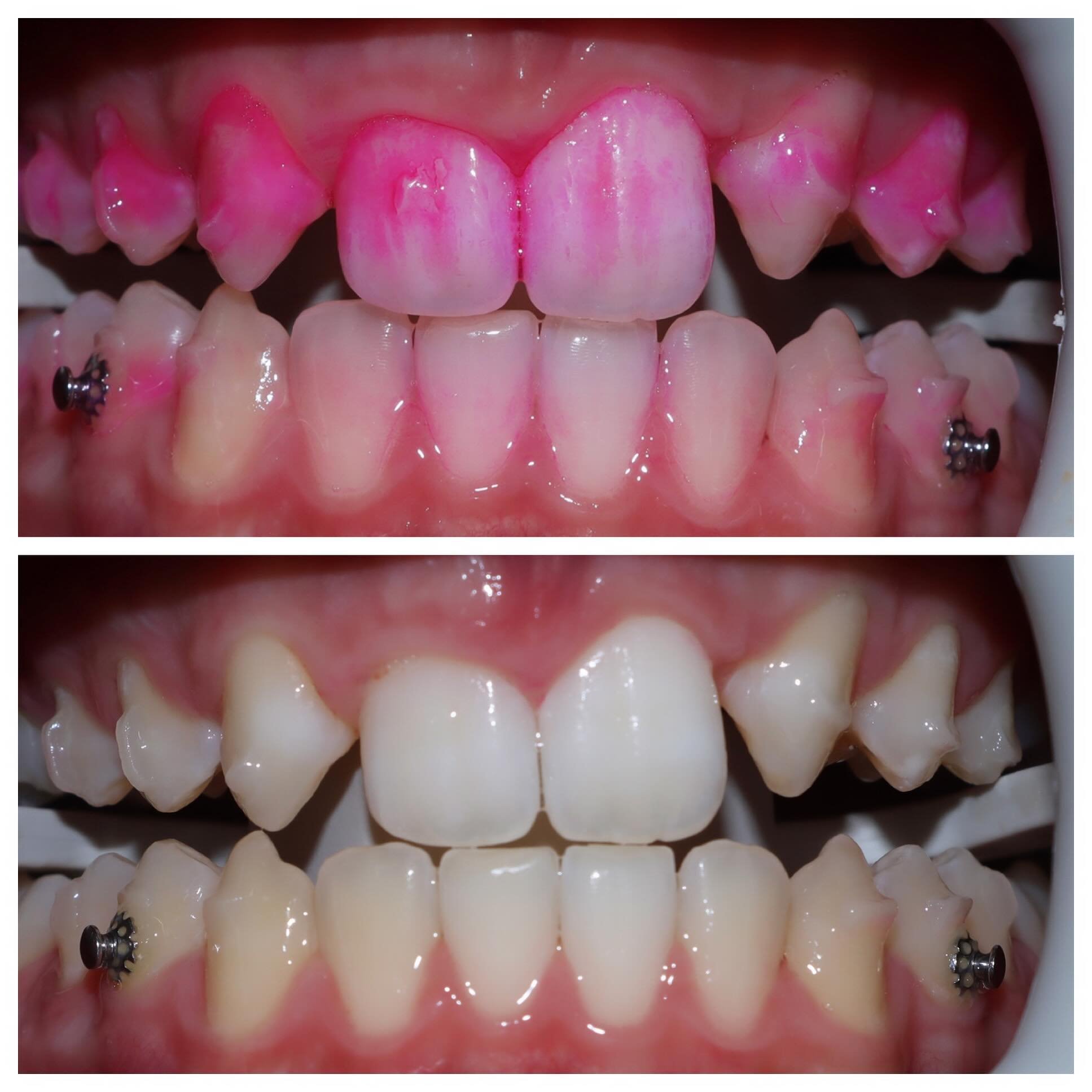 Disclosing solution is a great patient education tool that highlights the plaque/tartar on the teeth. The pink solution dyes the dental biofilm and gives a clear visualization of the present buildup. 

Here is our patient before and after their clean