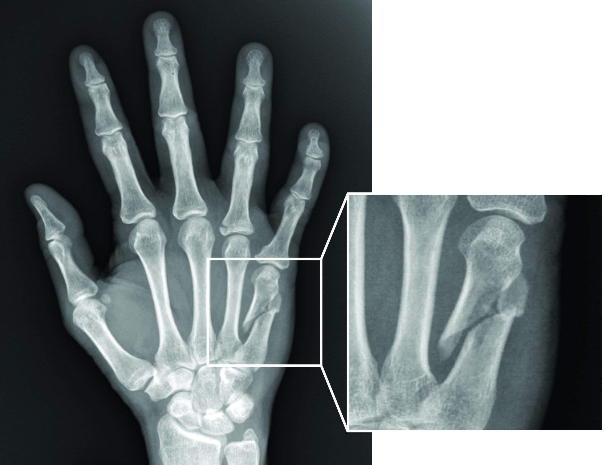 Hand Fracture Raleigh Hand Surgery — Joseph J Schreiber Md