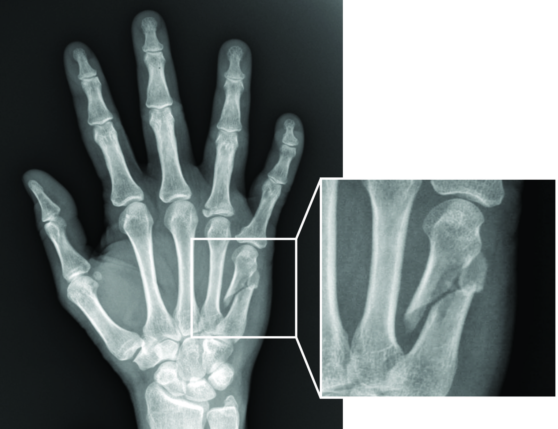 Hand Fracture Raleigh Hand Surgery — Joseph J. Schreiber, MD