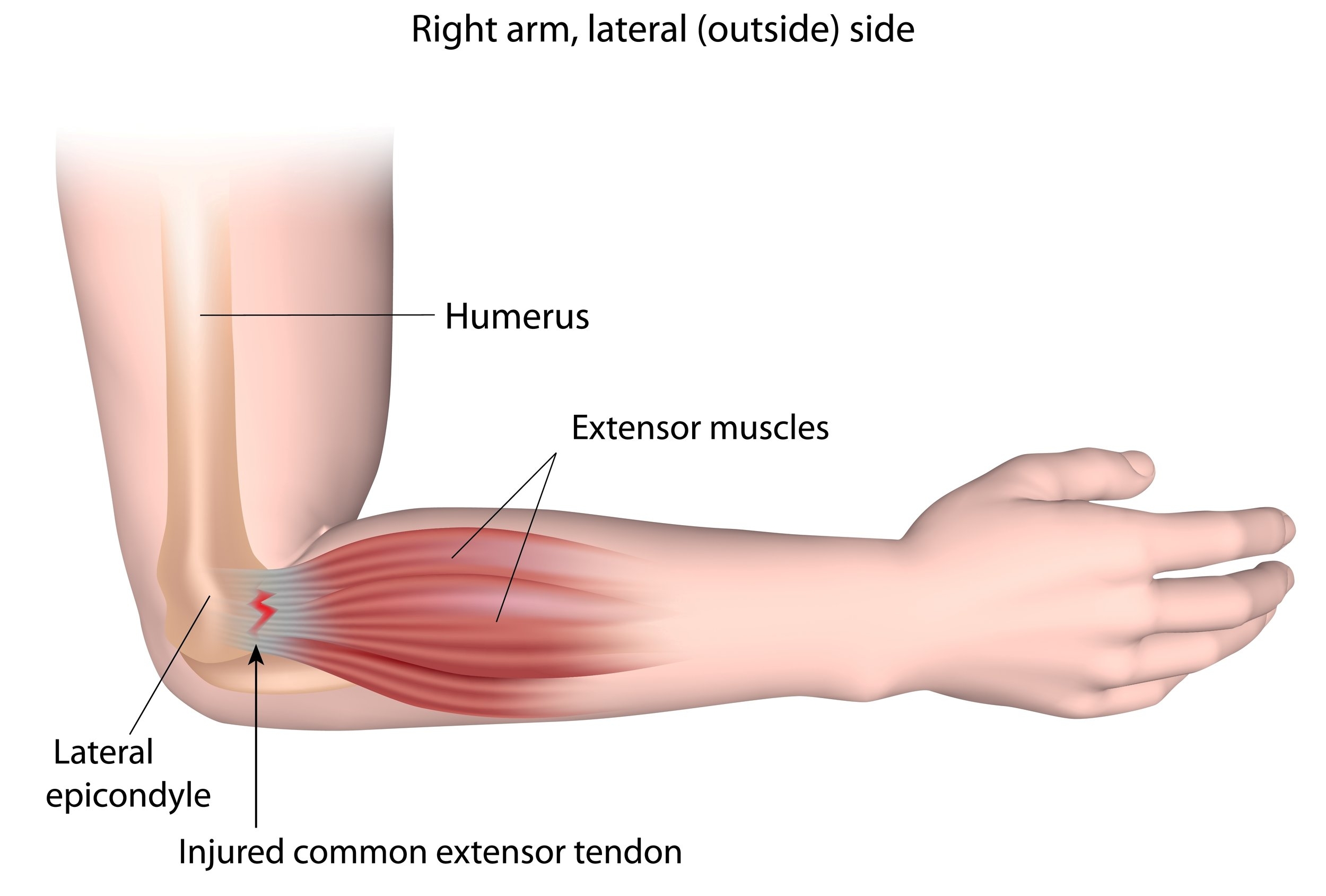Indeholde opkald Joke Tennis Elbow - Lateral Epicondylitis - Raleigh Hand Surgery — Joseph J.  Schreiber, MD