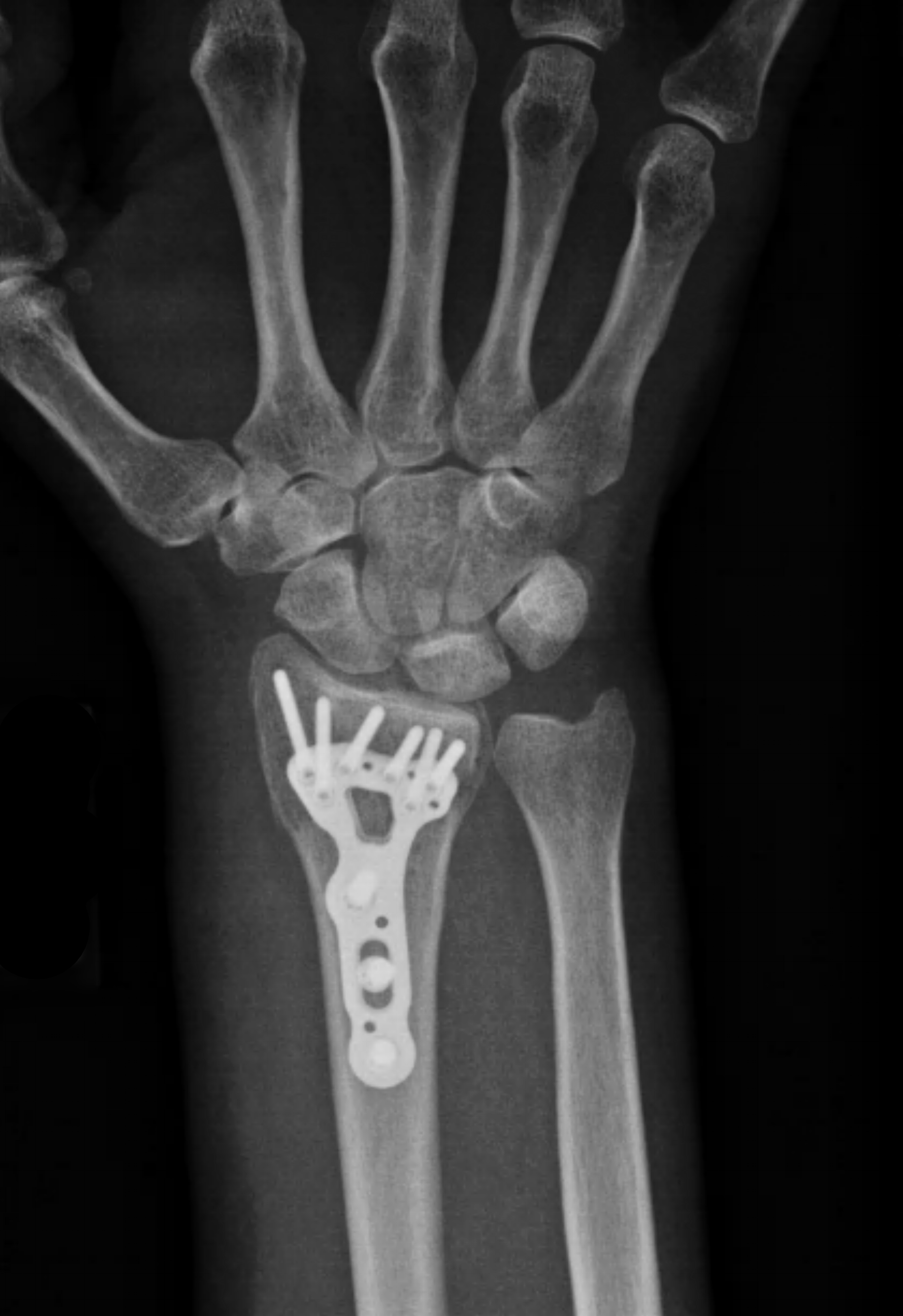 Hand Bone Fracture Distal Radius Fracture And Broken Arm Bone Types ...