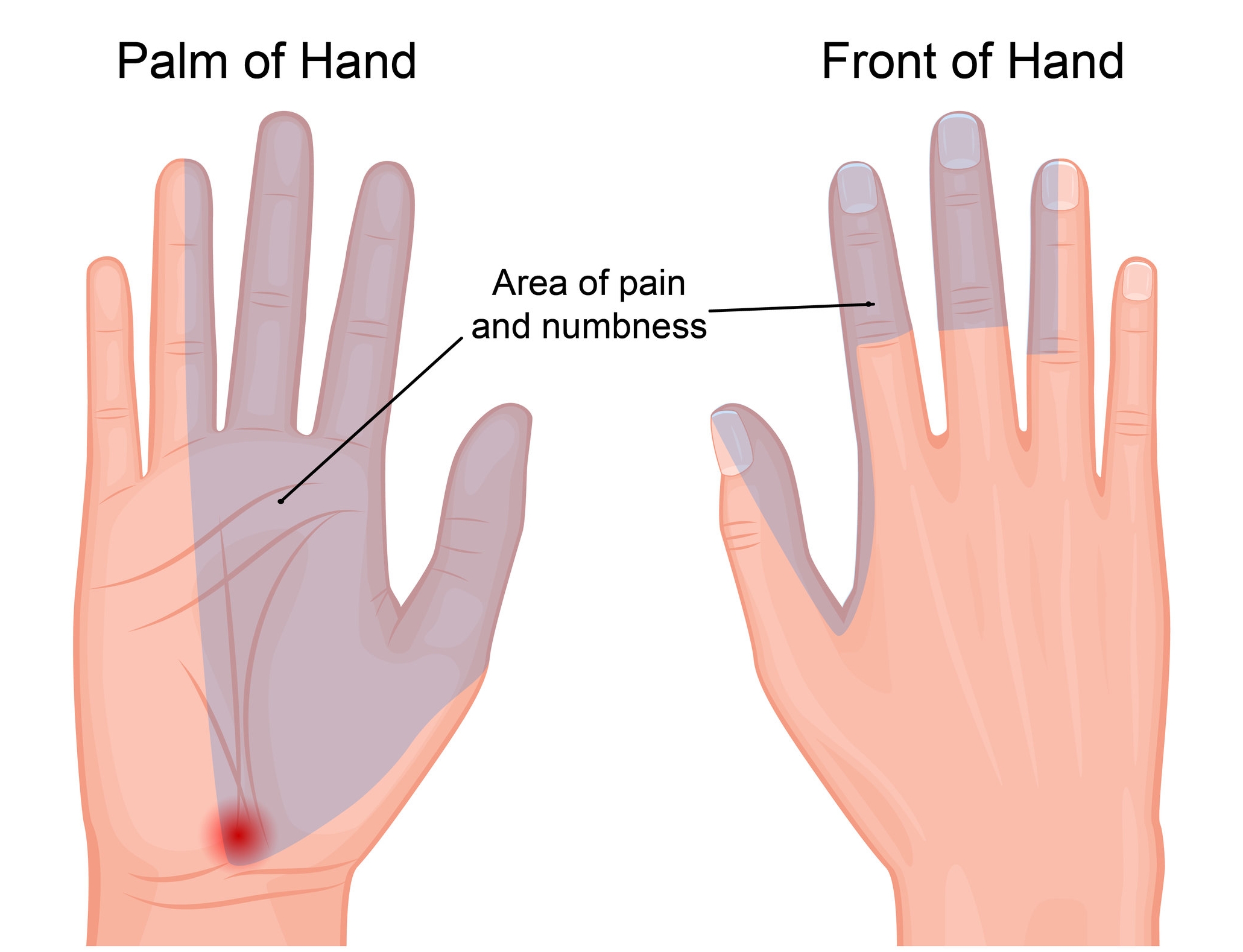Carpal Tunnel Syndrome - Raleigh Hand Surgery — Joseph J. Schreiber, MD