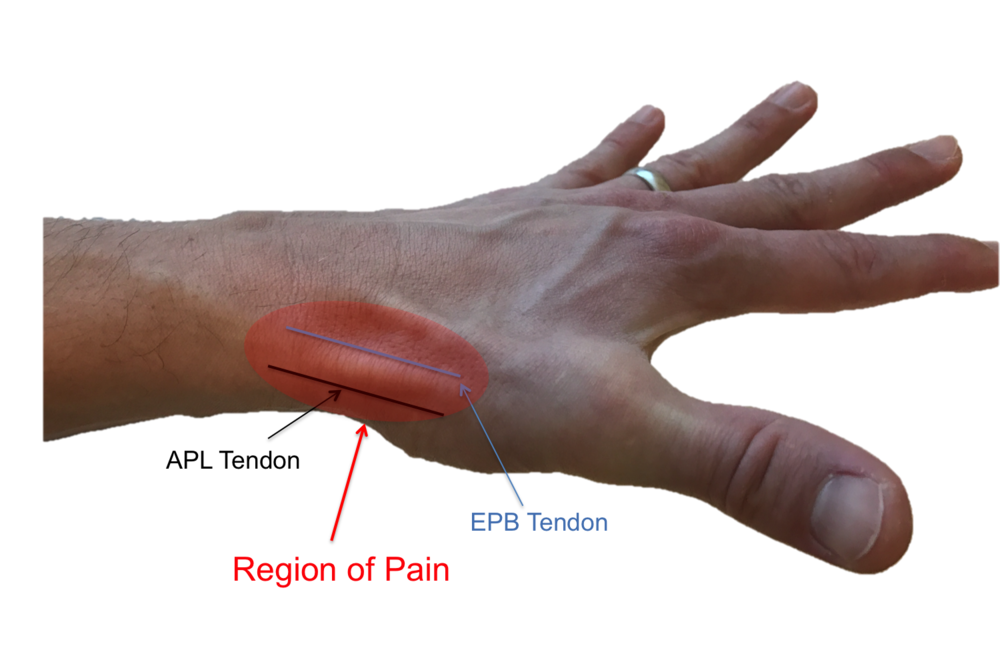 tendon release surgery wrist
