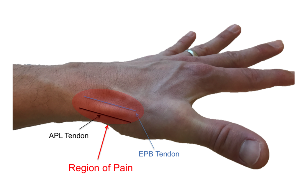 tendon release surgery wrist)