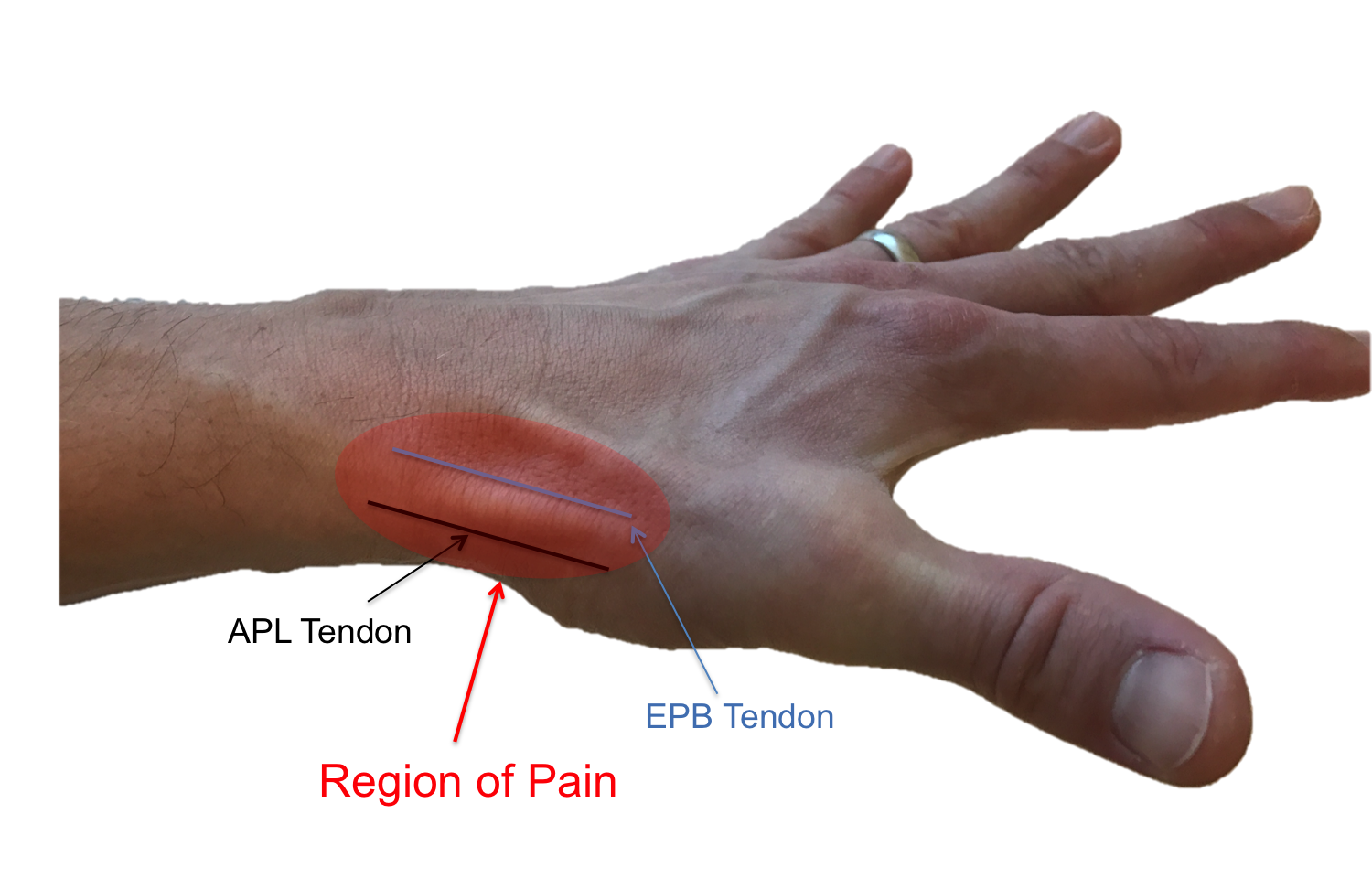 De Quervain S Tenosynovitis Surgery Slidesharetrick