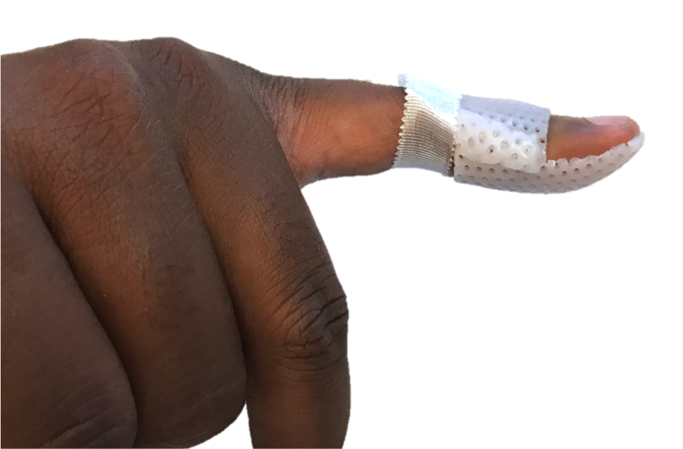 Mallet Finger Raleigh Hand Surgery — Joseph J. Schreiber, MD