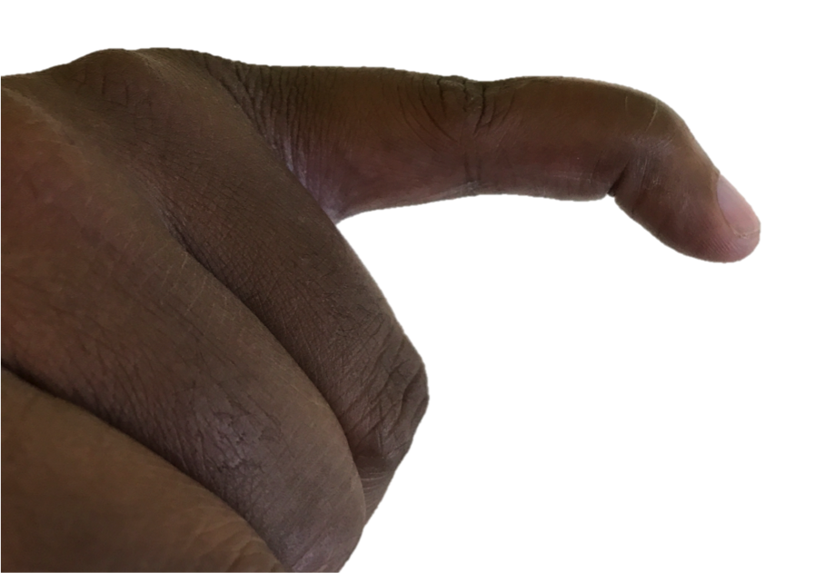 Mallet Finger Raleigh Hand Surgery — Joseph J. Schreiber, MD