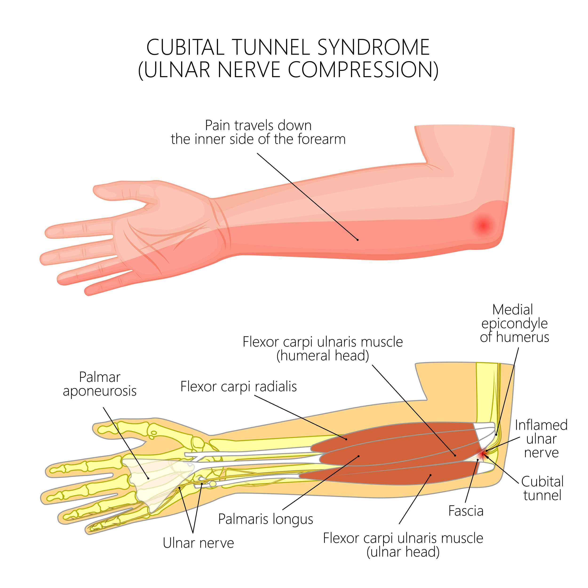 Cubital Tunnel Syndrome - Raleigh Hand Surgery — Joseph J. Schreiber, MD